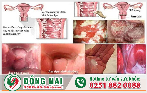 Triệu chứng điển hình của bệnh viêm âm đạo