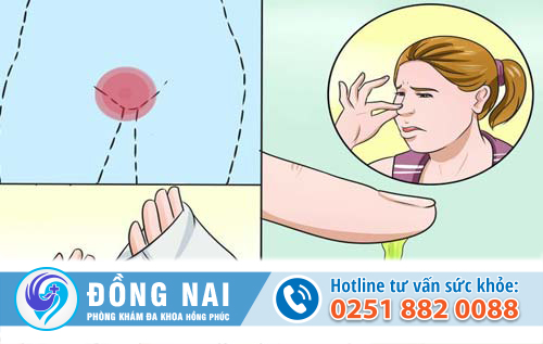 bệnh huyết trắng 