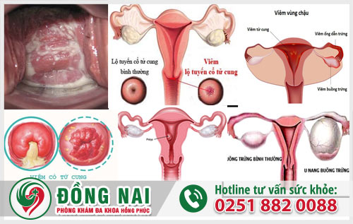 Một số bệnh phụ khoa thường gặp ở nữ giới