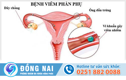 Bệnh viêm phần phụ là gì? Cách điều trị hiệu quả?