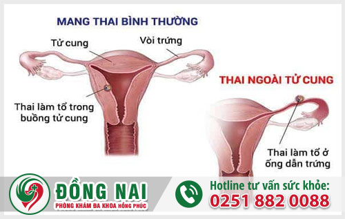 Tổng quan về bệnh viêm xương chậu