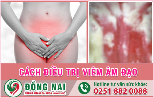 Cách Điều Trị Viêm Âm Đạo Hiệu Quả Nhất Hiện Nay