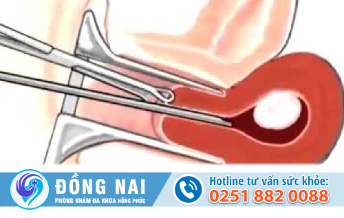 Cách hút thai được thực hiện như thế nào?