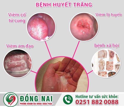 Huyết trắng ra nhiều hầu hết do nữ giới mắc các bệnh lý phụ khoa