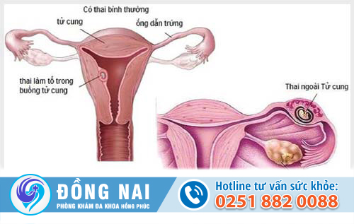 Thai ngoài tử cung có thể gây chảy máu vùng kín bất thường