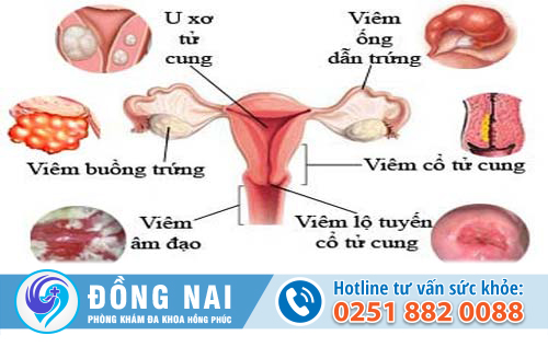 Đau bụng dưới và ra nhiều huyết trắng nguy cơ tiểm ẩn bệnh gì?