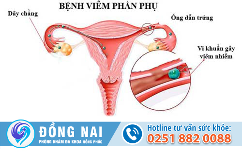 phương pháp điều trị viêm phần phụ hiệu quả