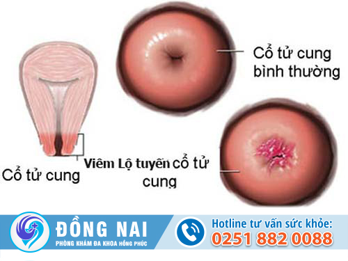  âm đạo chảy máu khi chưa tới tháng là bệnh gì?