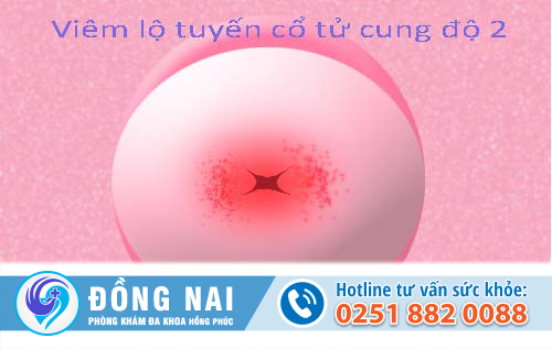 Hình ảnh các giai đoạn bệnh viêm lộ tuyến cổ tử cung