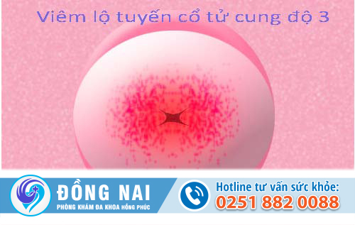 Hình ảnh các giai đoạn bệnh viêm lộ tuyến cổ tử cung