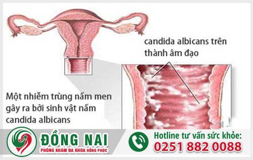Hình ảnh viêm âm đạo do nấm