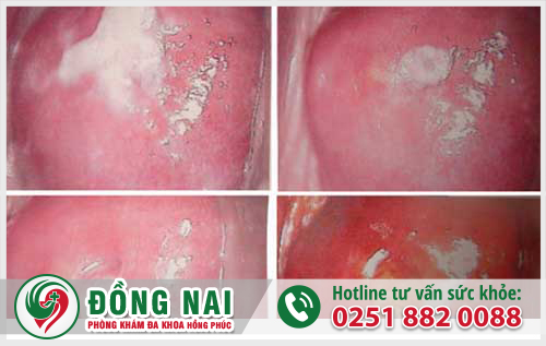 Hình ảnh âm đạo bị sưng tấy do viêm nhiễm