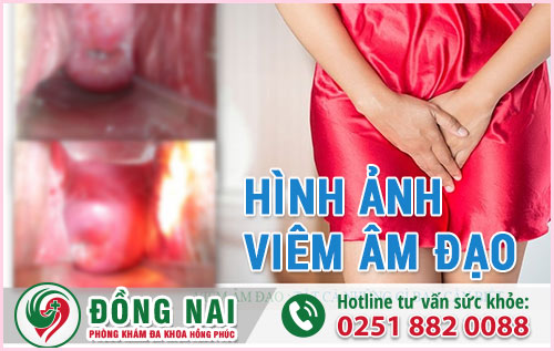 Một Số Hình Ảnh Viêm Âm Đạo Ở Nữ Giới