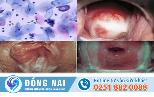 Hình ảnh viêm âm đạo