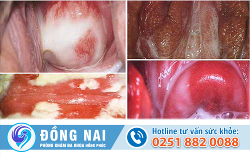 Hình ảnh viêm âm đạo