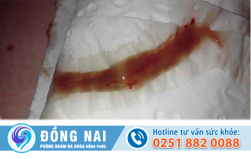 Khí hư màu đỏ và cách điều trị