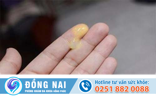 Khí hư màu vàng là biểu hiện của bệnh lý nào?