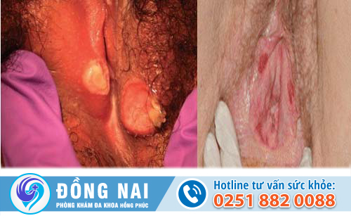 Lý do âm đạo bị lở loét