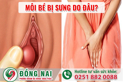 Môi bé bị sưng do đâu?