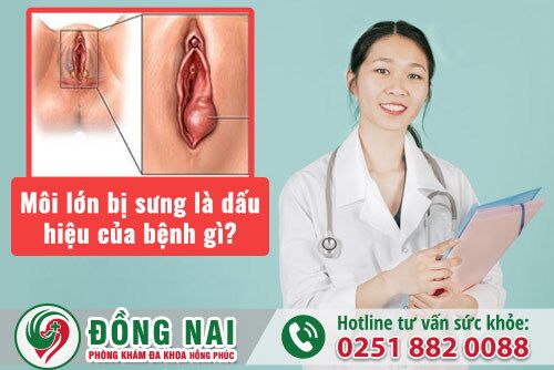 Môi lớn bị sưng là dấu hiệu của bệnh gì?