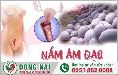 Bị nấm âm đạo thì phải làm sao?