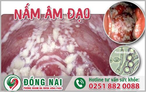 Bị nấm âm đạo thì phải làm sao?