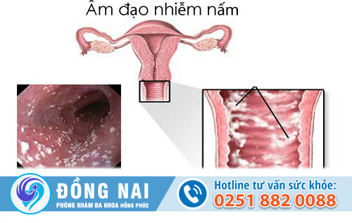 Nấm sinh dục Candida là gì?