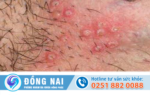 Nguyên do nổi hột ở vùng kín nữ và cách trị bệnh