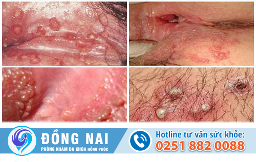 Nguyên do nổi hột ở vùng kín nữ và cách trị bệnh