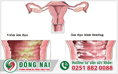 Viêm âm đạo gây ra hiện tượng chảy máu sau quan hệ