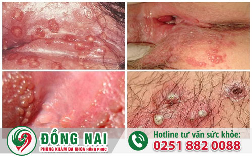 Sùi mào gà cũng là nguyên nhân gây chảy máu sau quan hệ