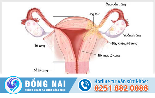 Nguyên nhân vô sinh nữ chủ yếu do bệnh phụ khoa