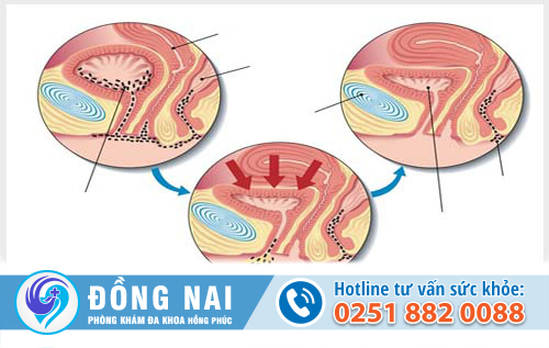 Vi khuẩn xâm nhập gây nhiễm trùng đường tiểu nữ