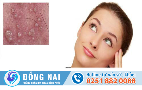 Nổi cục mụn cứng ở vùng mu là vì sao?