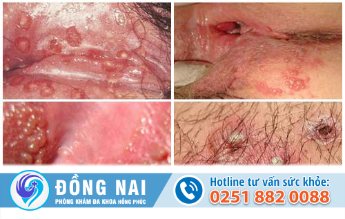 Nổi cục mụn cứng ở vùng mu là vì sao?