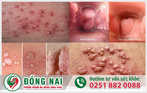 Hình ảnh triệu chứng bệnh gây nổi mụn âm đạo