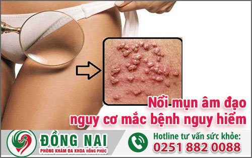 Nổi Mụn Âm Đạo Nguy Cơ Mắc Bệnh Nguy Hiểm