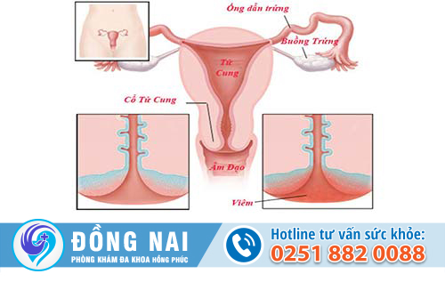 Bệnh phì đại cổ tử cung là như thế nào?