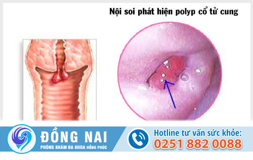 Polyp cổ tử cung là 1 dạng khối u