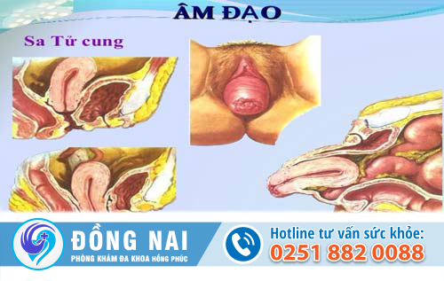 Sa cổ tử cung có nguy hiểm không?