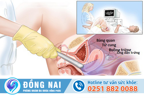 Siêu âm phụ khoa