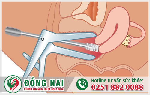 Kẹp mỏ vịt được sử dụng để mở rộng âm đạo giúp việc soi cổ tử cung được dễ dàng