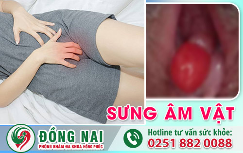 Sưng âm vật - ảnh báo nhiều bệnh lý nguy hiểm