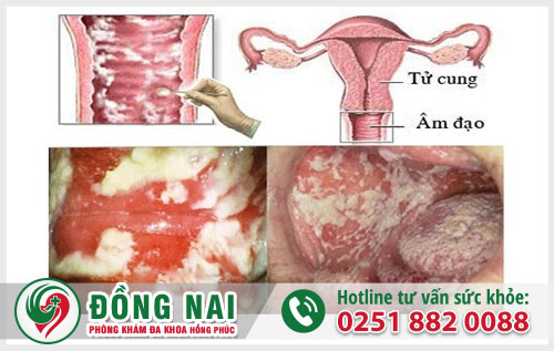 Tiểu khó ở nữ giới - cảnh báo bệnh nguy hiểm