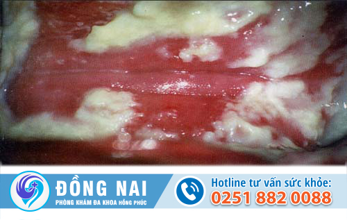 Tìm hiểu bệnh nấm vùng kín và cách chữa bệnh