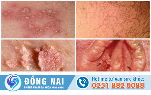 Tổng hợp về mụn sinh dục nữ giới