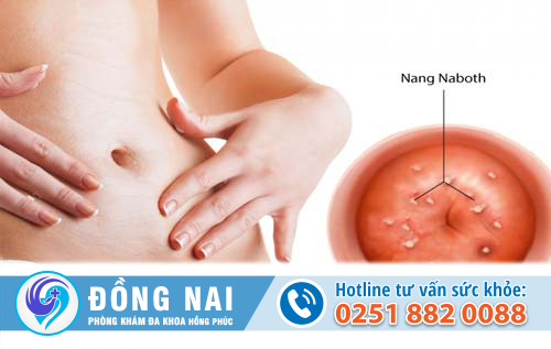 Triệu chứng nang naboth cổ tử cung