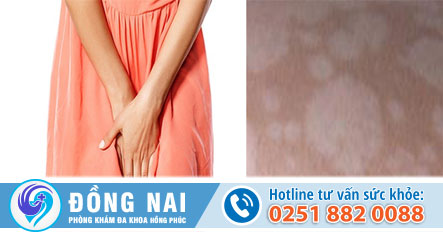 Vệt trắng bề ngoài âm đạo là do nguyên nhân gì gây nên?