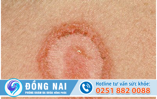 Vệt trắng bề ngoài âm đạo là do nguyên nhân gì gây nên?