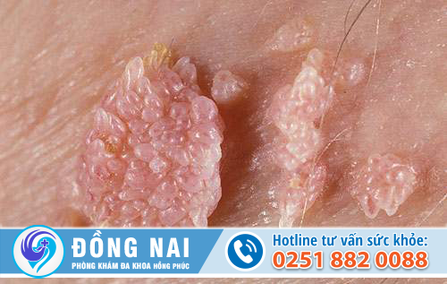 Vệt trắng bề ngoài âm đạo là do nguyên nhân gì gây nên?